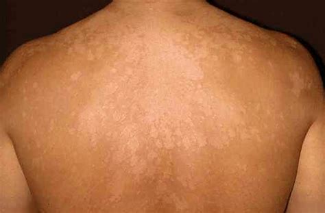 Tinea Versicolor Pityriasis Versicolor Skin Symptoms And Treatment