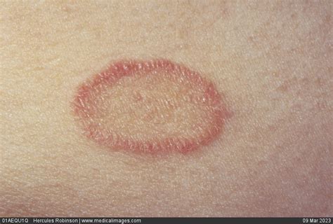 Stock Image Close Up Of Pityriasis Rosea Showing A Red Scaly Herald