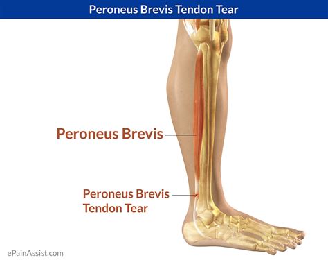 Peroneus Brevis Tendon Tear Symptoms Causes Treatment Exercises Sports Massage