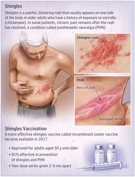 Private Shingles Vaccination With New Shingles Vaccine Clinic In London