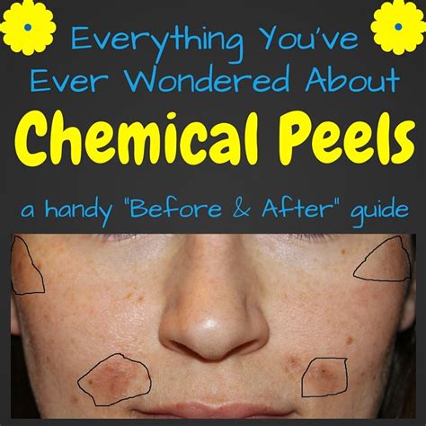 Chemical Peel Before And After Chemical Peel Jessner Peel Peeling Skin