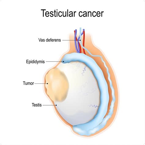 Discussing Testicular Cancer With Your Partner