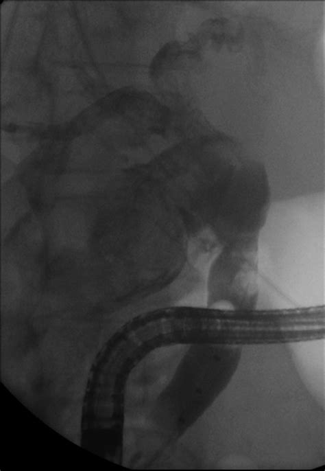 Ercp Showing Large Filling Defect In The Proximal Cbd Close To The