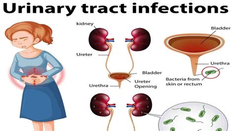 Actionable Urinary Tract Infection Treatment Tips That Work Like A Charm