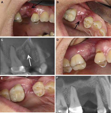 Osteonecrosis Of The Jaw In The Absence Of Antiresorptive Or
