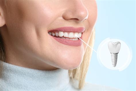 Top 4 Dental Prosthesis Options And Which Is Best For You Stabili Teeth
