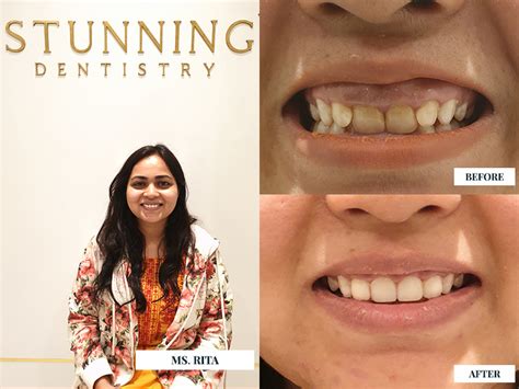 Different Options From Cosmetic Dentistry To Design Your Smile Stunning Dentistry Blog