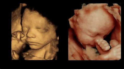 Our 3d4d Scan Explained Window To The Womb