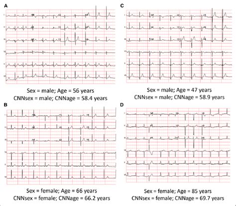 Example Electrocardiograms From Patients Comparing Actual Age And Sex Download Scientific