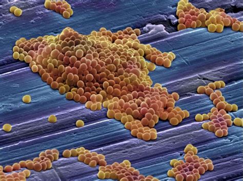 Mrsa strains of germs (bacteria) are no more aggressive or infectious than other strains of s. MRSA (methicillin resistant staphylococcus) - serious even ...