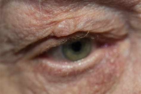 Skin Cancer And Eyelid Tumors