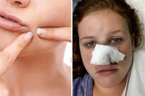 This Womans Pimple Was The First Sign Of Cancer Heres What To Look