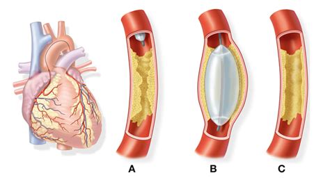A Balloon Angioplasty Is Used To Photos