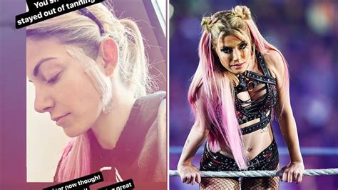 Wwe Star Alexa Bliss Reveals Skin Cancer Battle As She Calls On Fans To Get Checked If Using