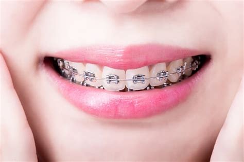 4 Common Problems With Braces And How To Avoid Them King Orthodontics