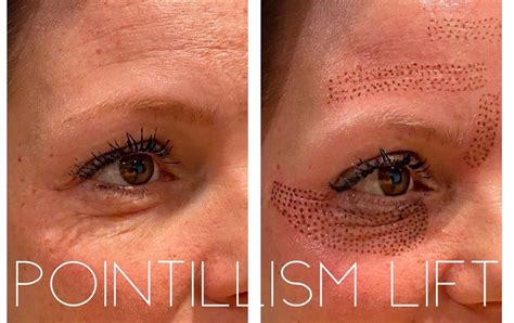 Best Under Eye Wrinkle Treatment Beauty Health