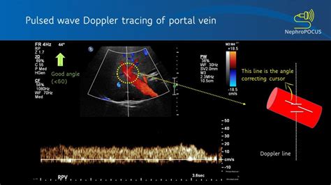 Basics Of Doppler Ultrasound For The Nephrologist Part 2 Renal
