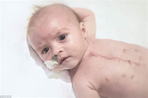 Chd Babies In Australia Show Scars From Surgery Daily Mail Online