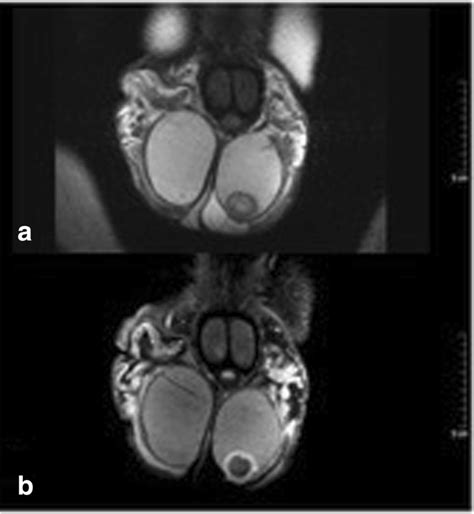 A Patient Adult With Complex Testicular Epidermoid Cyst Scrotal Mri