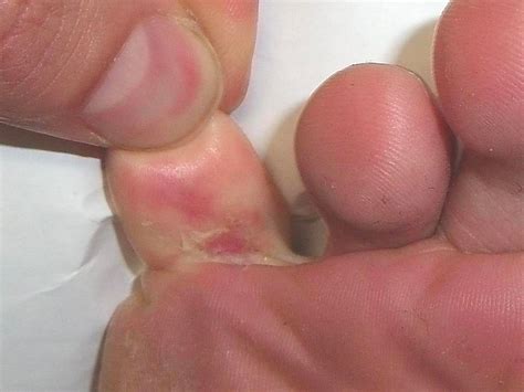 Athlete S Foot Fungal Skin Infection East Devon Podiatry