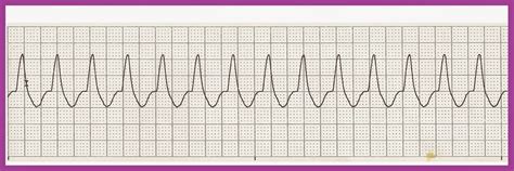 Nei soggetti a rischio anche un brutto sogno può scatenare improvvisamente un'aritmia che porta a. Float Nurse: Practice EKG Rhythm Strips 228