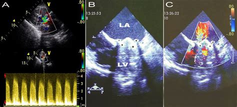 Echocardiography Of Mitral Prosthesis A Transthoracic Echo Reveals