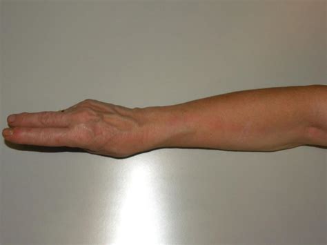 Lymphangitis Causes Symptoms And Pictures