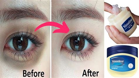 Remove Dark Circles In Days With Vaseline Permanently Dark Circles Under Eyes Home Remedy