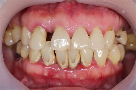 Gum Disease Alert 5 Key Signs You Shouldnt Ignore