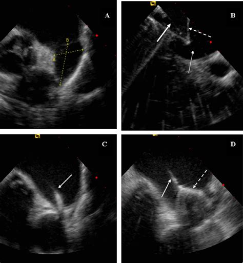 Use Of Intracardiac Echocardiography To Guide Implantation Of A Left