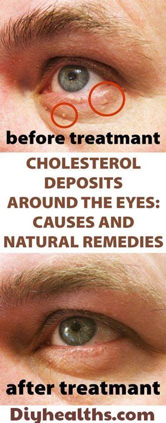 Clean All The Cholesterol Deposits Around Your Eyes Xanthelasma Is
