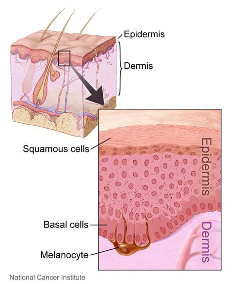 What Is Basal Cell Carcinoma Sero
