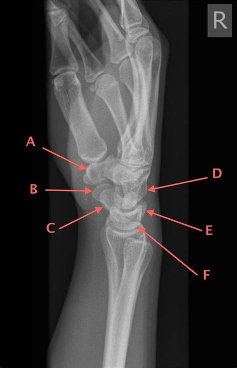 Wrist Bone Anatomy Radiograph