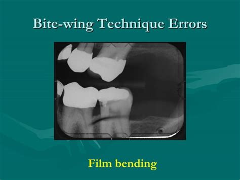 Bite Wing And Technique Errors Lecture1