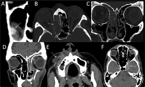 E Varied Findings Of Mucormycosis On Computed Tomography In Covid