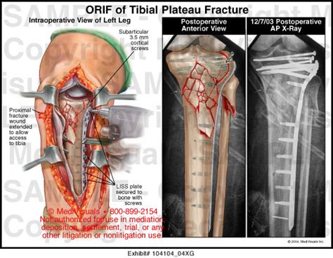 Orif Of Tibial Plateau Fracture 10410404xg