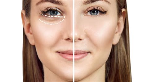 How To Remove Bags Under Eyes Permanently Or Instantly PERFECT