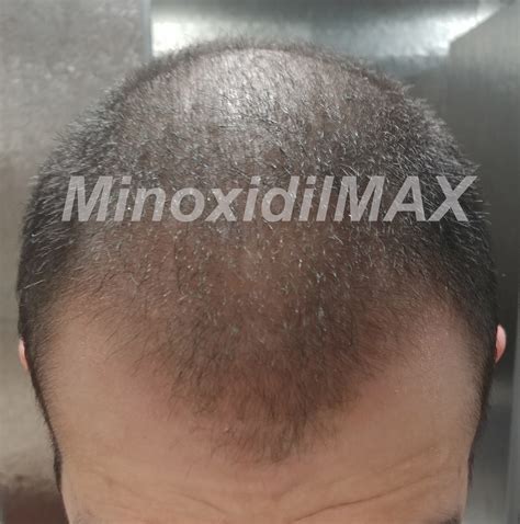 Minoxidil Results Before And After Amazing Pictures