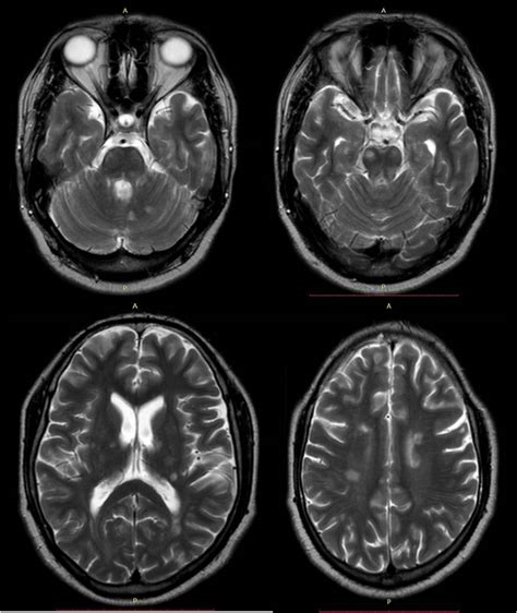 1 magnetic resonance imaging (mri) of the brain is useful in the diagnosis and treatment of multiple sclerosis. SSRD - Interesting Cases - Multiple Sclerosis - MRI images