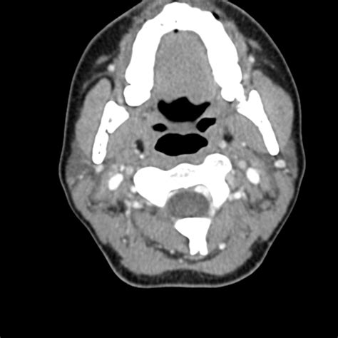 Normal Ct Of The Neck Image