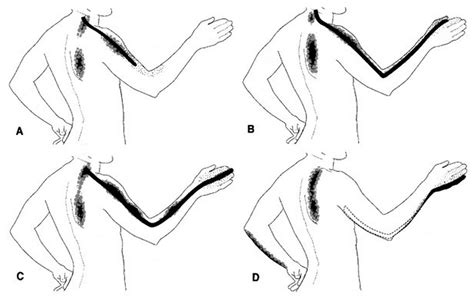 Cervical Radiculopathy Spine Orthobullets