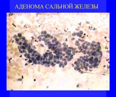 Причины возникновения гиперплазии сальных желез более глубокие, чем кажется на первый взгляд. Аденома сальных желез - фото, симптомы, лечение и прогноз