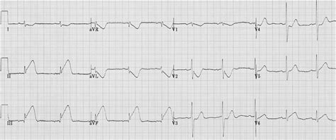 Ecg Of A Patient With Acute Inferior Myocardial Infarction A There