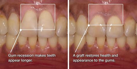 Fortunately, a gum graft can help. Gum Grafting