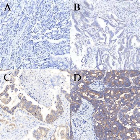 Immunohistochemical Staining For Braf V600e In Colorectal Cancer A D Download Scientific