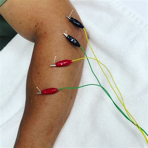 Dry Needling Protocol For Lateral Epicondylitis Or Tennis Elbow