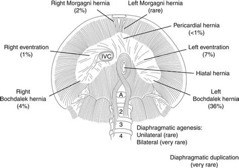 Congenital Diaphragmatic Hernia Thoracic Key