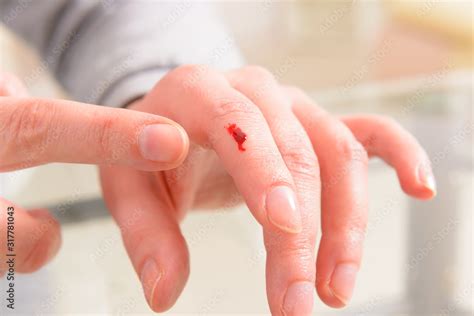 Bleeding Finger Hand With A Wound Stock Photo Adobe Stock