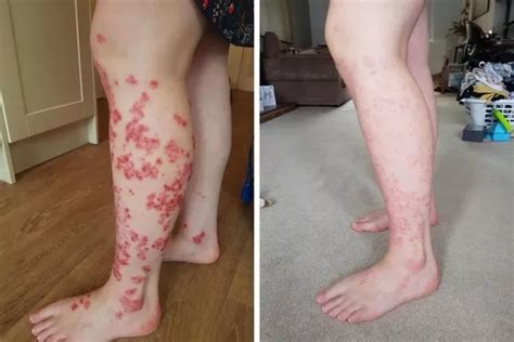 Psoriasis Sufferer Praises This £7 Cream For Finally Clearing Flare Ups And Shares Incredible