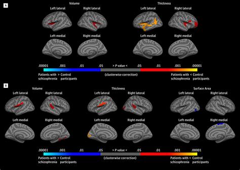 Association Of Iq Changes And Progressive Brain Changes In Patients